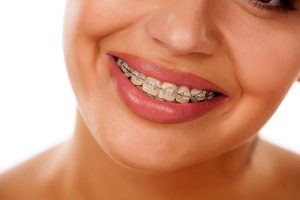 smiling female mouth with braces on her teeth