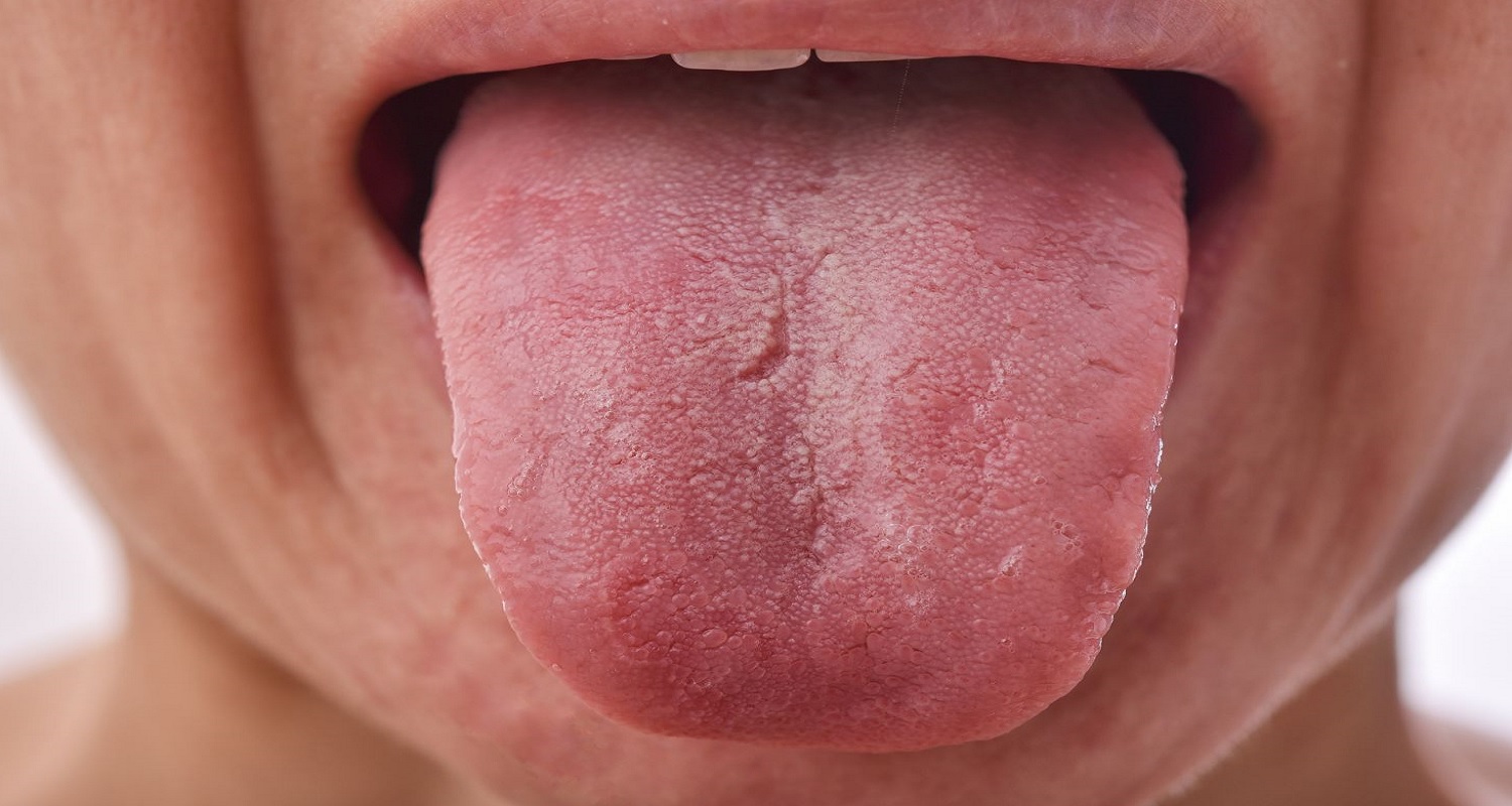 tongue disease