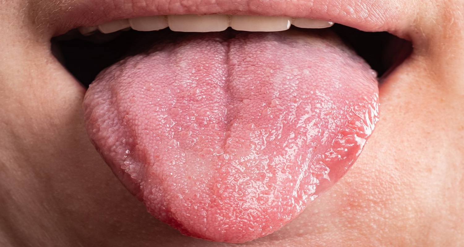 diseases of the tongue