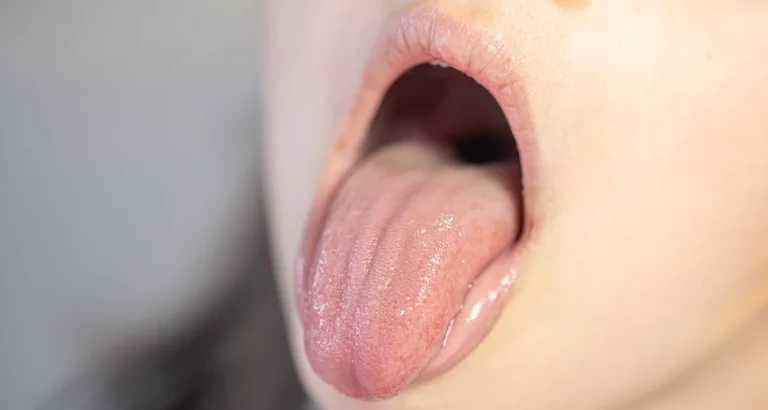 Diseases of the Tongue