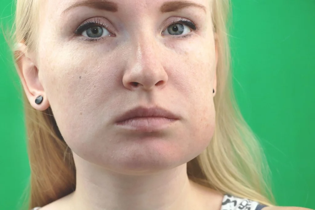 woman-with-swollen-cheeks