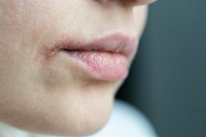 woman-with-cold-sore