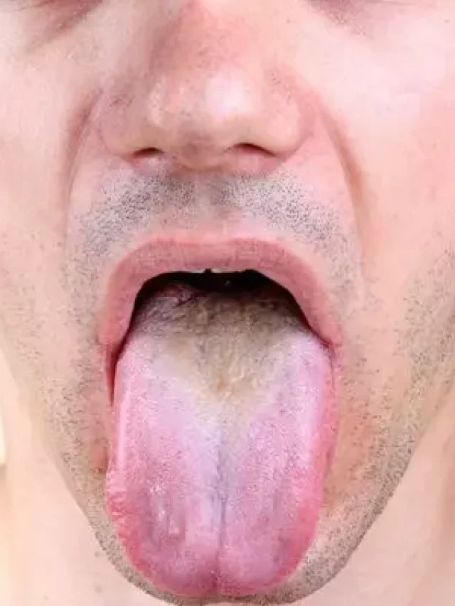 Enfermedades de la lengua