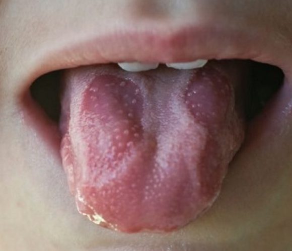 kid-with-tongue-disease
