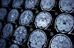 mri-results-of-a-brain-with-epilepsy