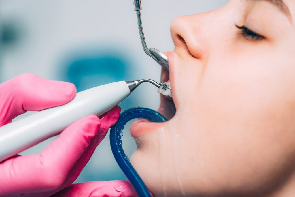 orthodontist-cleaning-girl's-teeth