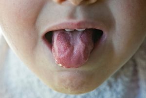 kid-with-tongue-disease