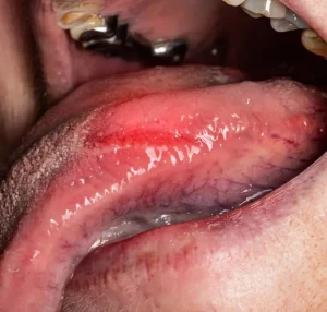 close-up-diseases-of-the-tongue