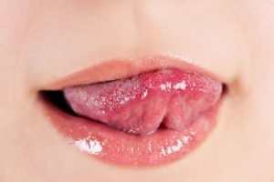 Lingual Papillitis