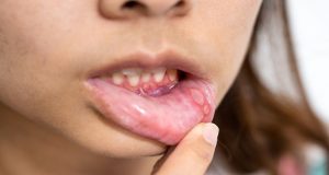 infection in the mouth