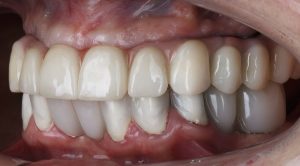 mouth-with-dental-cavities