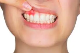 Infección en las encías. Foto de una mujer con infección en las encías.