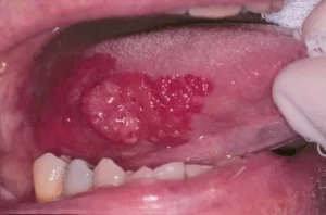 Enfermedades de la lengua