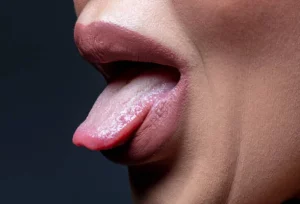 Papilitis lingual transitoria. Foto de mujer mostrando la lengua con síntoma de quemazón debido a la papilitis lingual transitoria.