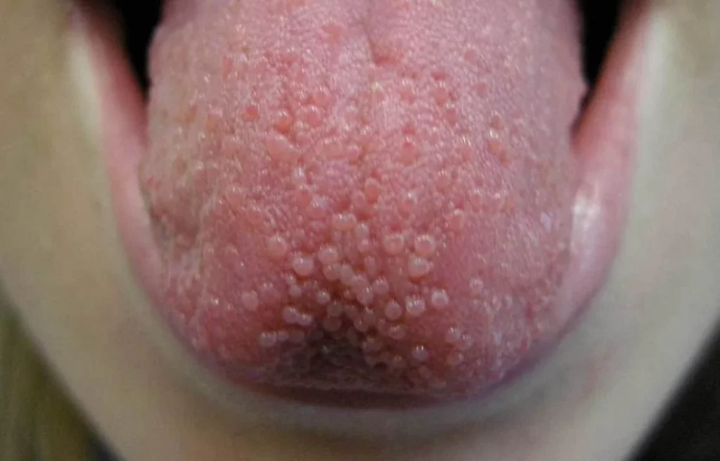 Appearance of Transient Tongue Papillitis