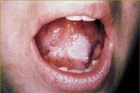 Erythroplakia: Premalignant Lesions