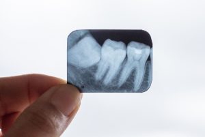 dentist-holding-an-x-ray-of-wisdom-tooth