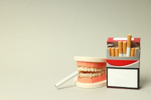 Dentadura afectada por el consumo de cigarrillos con ESTOMATITIS POR NICOTINA