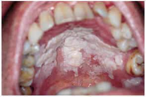 Paladar afectado por la estomatitis por nicotina