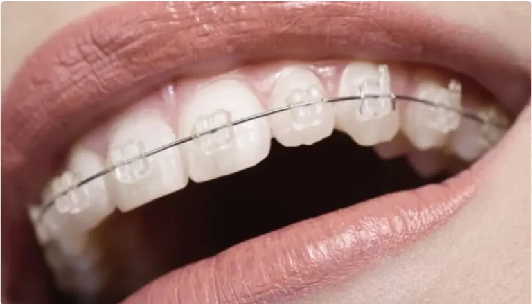 Qué saber antes de ponerse Brackets? Tipos de Brackets