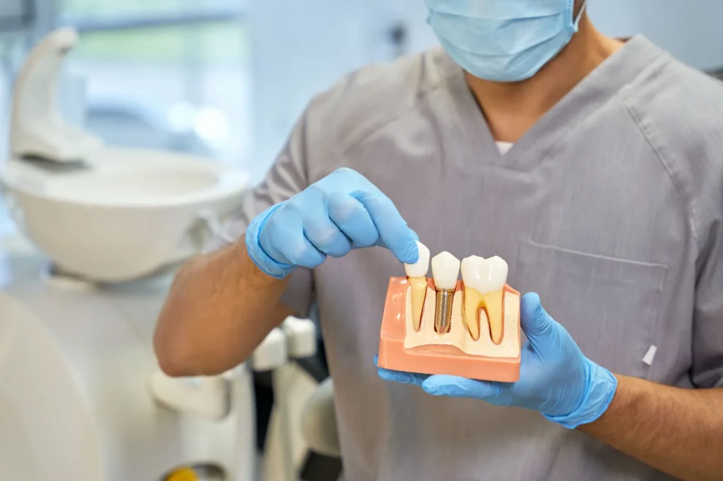 Los Mejores Implantes Dentales En Oxnard