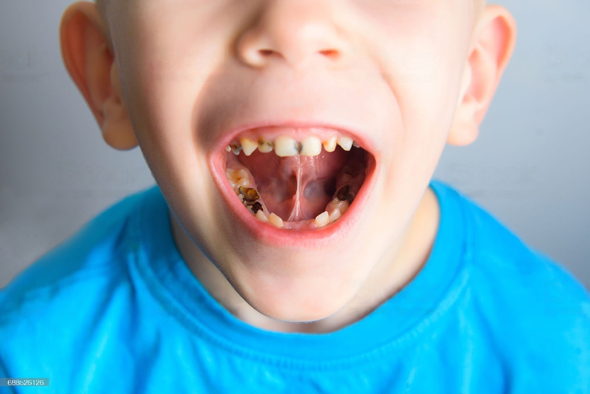 caries en niños pequeños