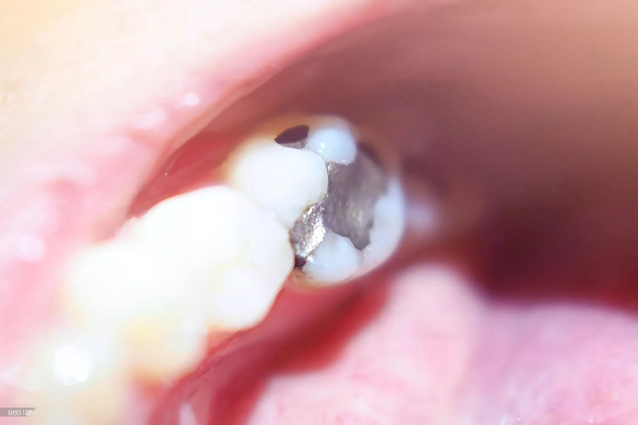 empaste dental para tratamiento de caries