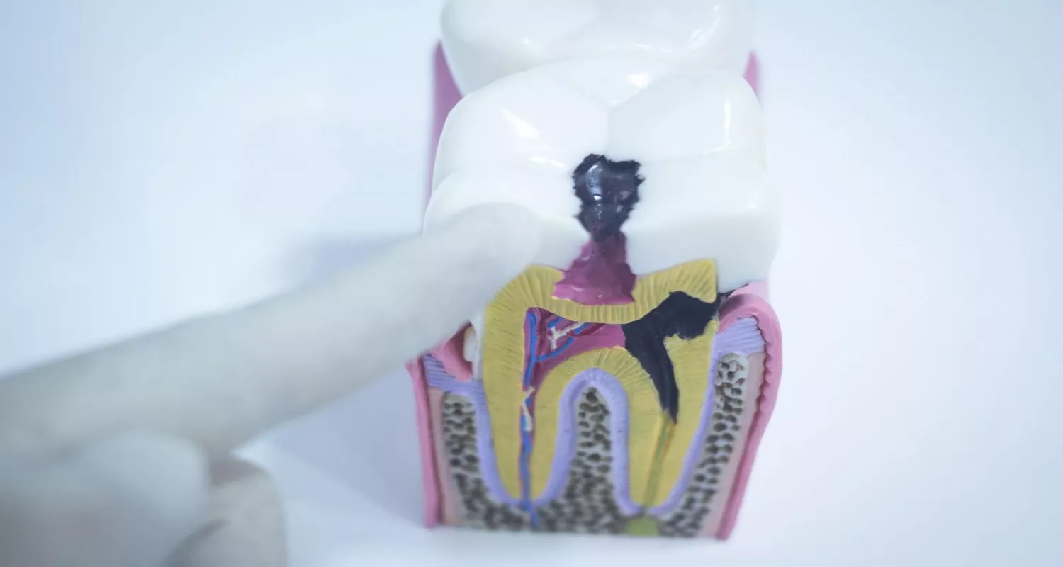 Aceites Esenciales para el Dolor de Muelas