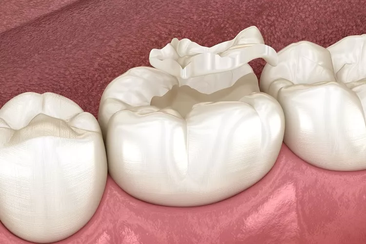 dental crown