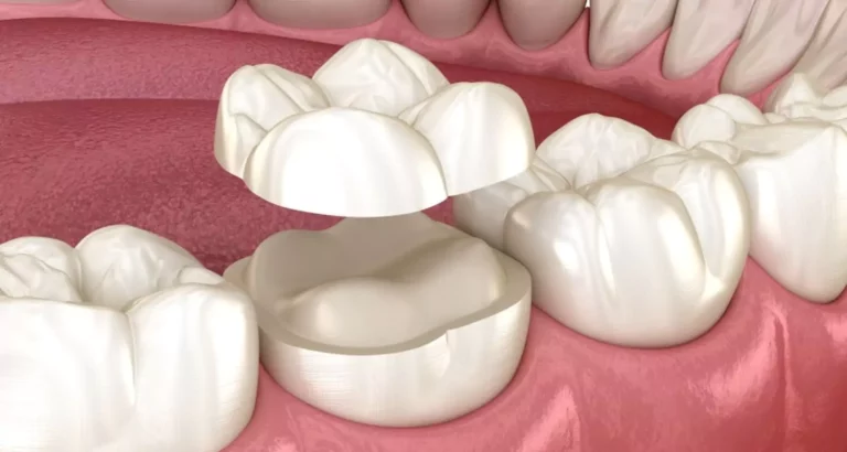Dental Onlays