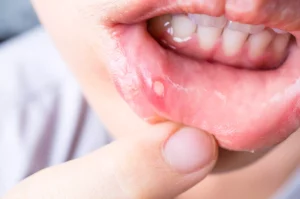 Aloe Vera Gel For Mouth Ulcers: 4 Comprehensive Benefits