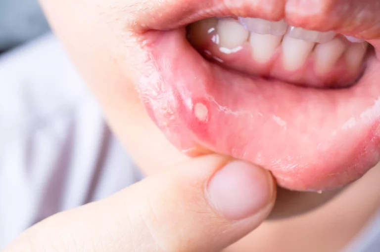 Aloe Vera Gel For Mouth Ulcers: 4 Comprehensive Benefits