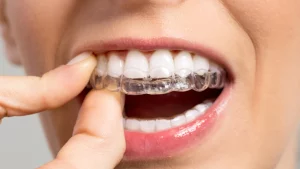 invisalign aligners