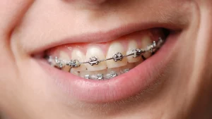metal braces