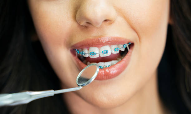 teeth braces
