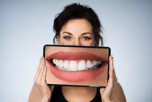 clear-braces-3-679a5a7f17d14