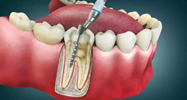 Step 5: removing the infected pulp