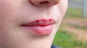 Does a Lip Sunburn Raise Oral Cancer Risk?