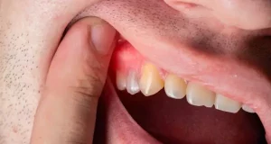 What are the dental benefits of avocados?
