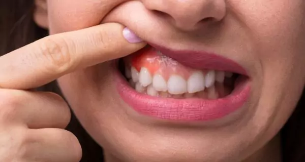 What is the connection between arthritis and gum disease?