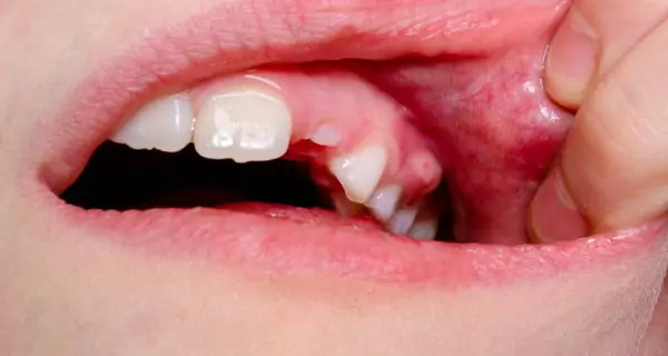 Can cavities cause infections?