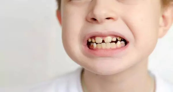 What complications can childhood bruxism cause?