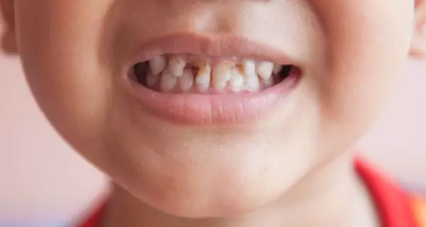 What signs show toddler tooth decay?