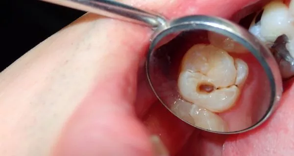¿Cómo reconocer una caries en etapa temprana?
