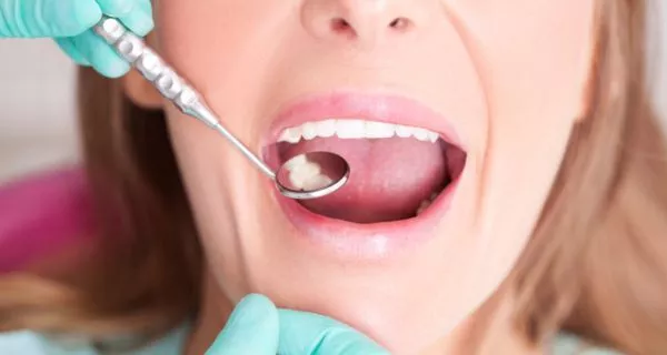 ¿Las caries desaparecen por sí solas?