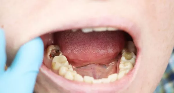 ¿Qué son las caries y cómo se forman?