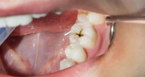¿Cómo se relacionan las caries con el mal aliento?