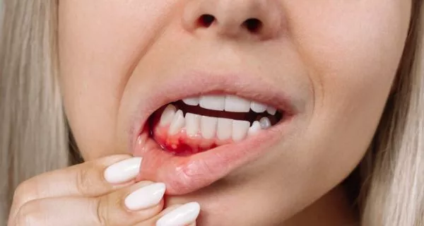 ¿Cuándo se recomienda una limpieza dental profunda?