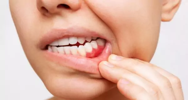 ¿Qué efectos tiene la radioterapia en la salud bucal?
