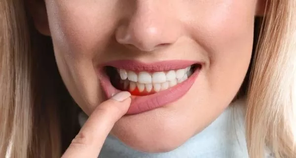 ¿Qué son las enfermedades de las encías?